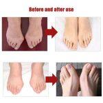 Silicon Gel Splint Corrector for Big Toe - Image 9