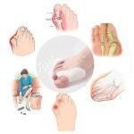 Silicon Gel Splint Corrector for Big Toe - Image 6